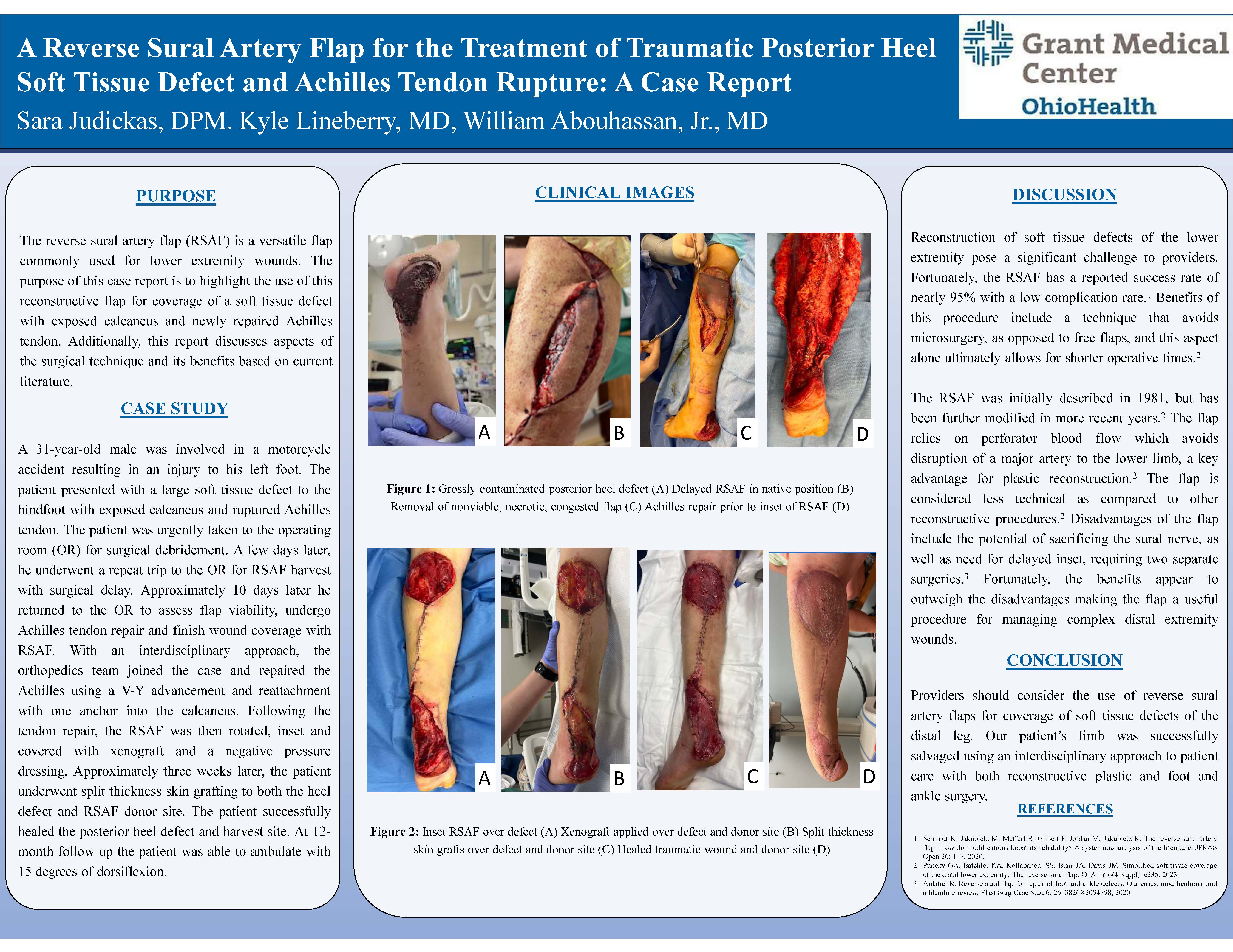 Distally Based Peroneus Brevis Muscle Flap for Treatment of Distal Third Lower Extremity Defects in the Multimorbid Patient Population