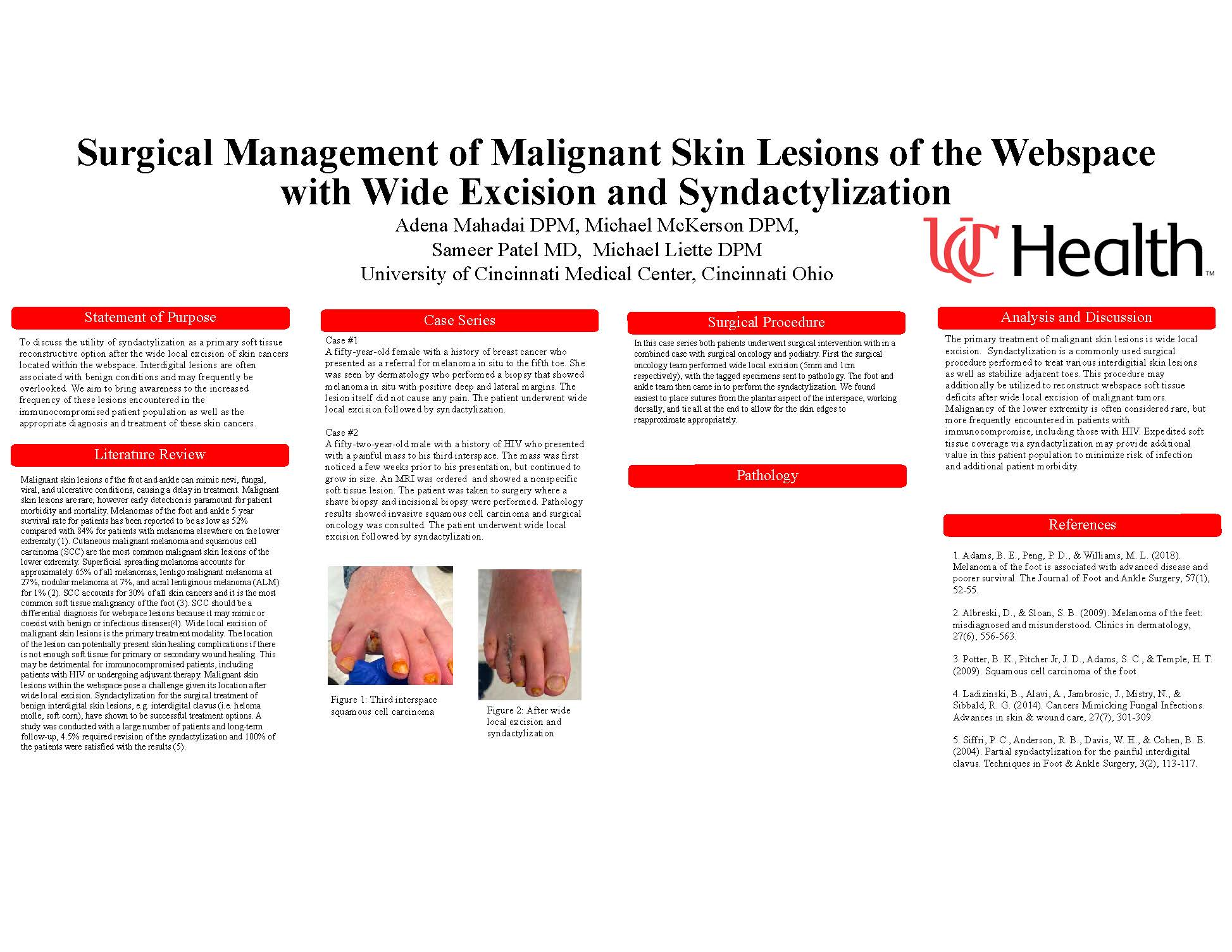 Periprosthetic Total Ankle Replacement Fractures