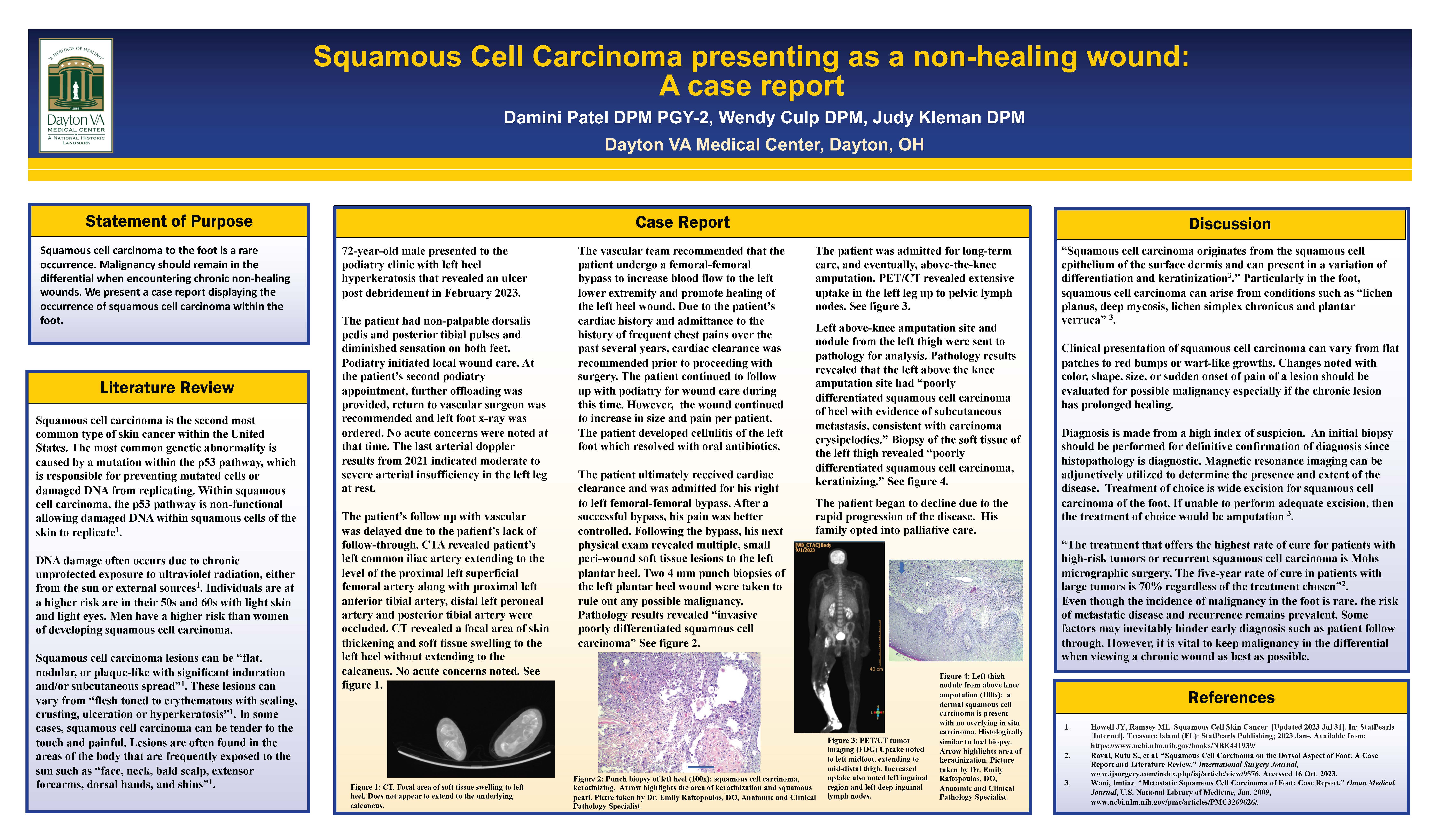 Squamous Cell Carcinoma Presenting as a Non-Healing Wound