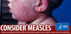 measles